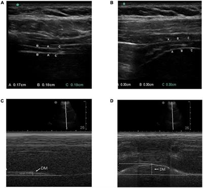 Repetitive transcranial magnetic stimulation combined with respiratory muscle training for pulmonary rehabilitation after ischemic stroke—A randomized, case-control study